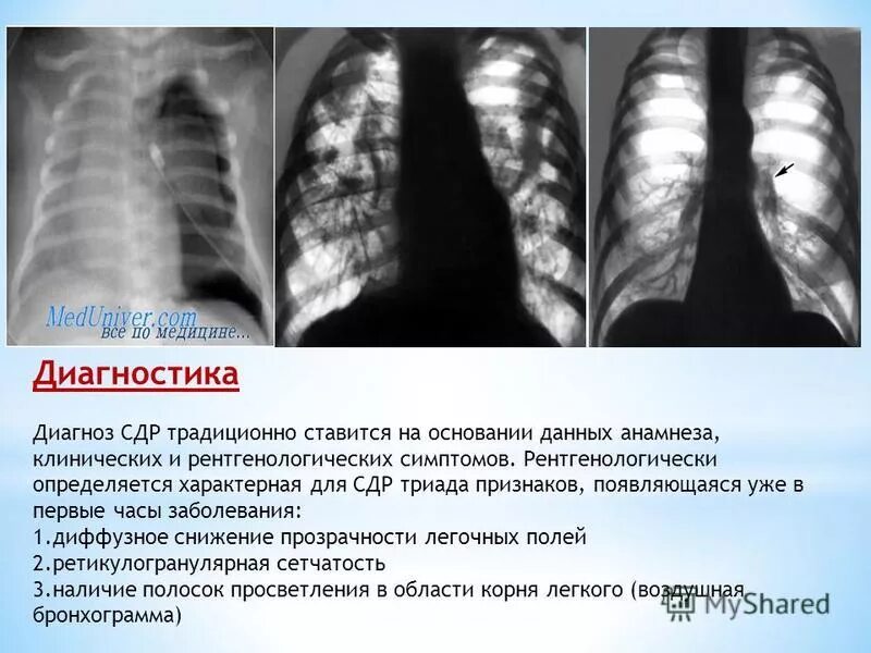 Мм 4 диагноз. Бронхограмма корня лёгкого. Рентгенологический симптом “мышиного хвоста’ характерен для:. СДР это в медицине. Рентгенологический симптом "плакучей ивы".