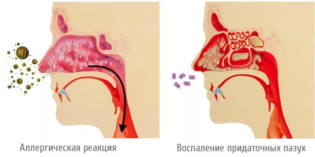 Можно ли проглатывать мокроту. Синусит, ринит, гайморит у ребенка.