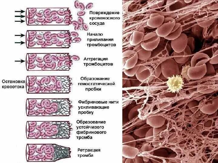 Тромбоцитарный тромб и фибриновый тромб. Сгусток крови под микроскопом. Тромбоциты в микроскопе. Образование тромбоцитов гистология.