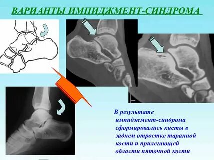 Задний импинджмент голеностопного