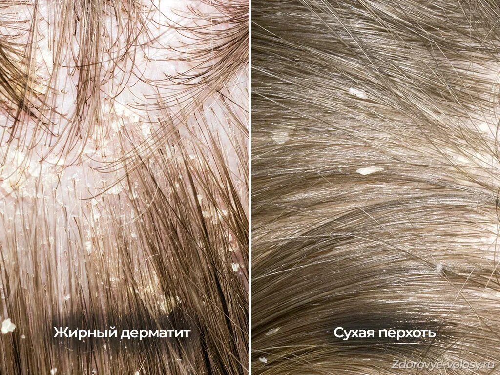 Сухая голова виды. Сухая голова виды. Сухая голова виды. Себорейный дерматит и перхоть. Чистые волосы.