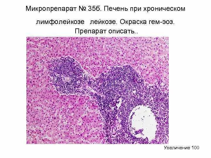 Печень микропрепарат описание. Хронический лимфолейкоз печени микропрепарат. Печень при остром миелолейкозе микропрепарат. Макропрепарат при остром лейкозе. Лимфома селезенки гистология.