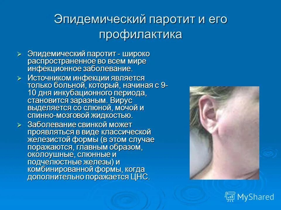 Какие признаки свинки. Эпидемический паротит Свинка симптомы. Симптомы болезни паротит. Свинка эпидемический паротит клиника. Заболевания Свинка инфекционные заболевания.