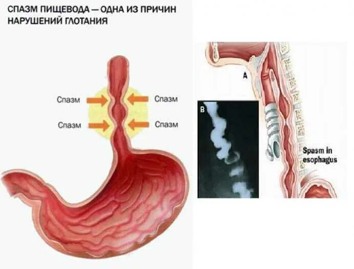 Дисфагия и спазм пищевода. Эзофагоспазм патогенез. Спастические сокращения пищевода. Диффузного спазма пищевода.