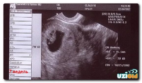 7 weeks. УЗИ на 7 акушерской неделе беременности. Ребенок 7 акушерская неделя УЗИ. УЗИ 7 недель беременности. Размер эмбриона на 7 неделе беременности.