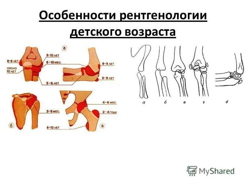 Перелом по типу зеленой веточки. Особенности переломов костей у детей. Особенности повреждения опорно двигательного аппарата у детей. Рентгенологическая классификация переломов костей. Особенности переломов костей у детей.