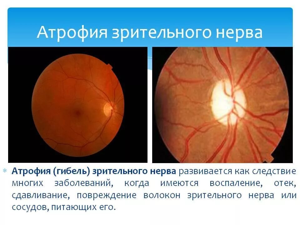 Нисходящая атрофия. Патогенез атрофии зрительного нерва. Неврит зрительного нерва (воспаление зрительного нерва). Атрофия зрительного нерва осложнения. Вторичная постзастойная атрофия зрительного нерва.