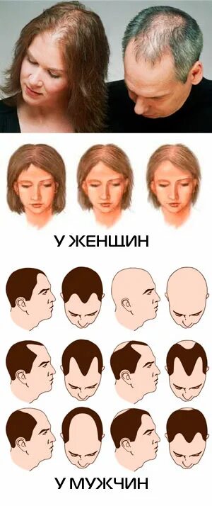 Типы облысения у женщин. Стрижки при андрогенной алопеции у мужчин. выпадение волос по мужскому типу. андрогенная алопеция по мужскому типу. андрогенная алопеция у женщин.