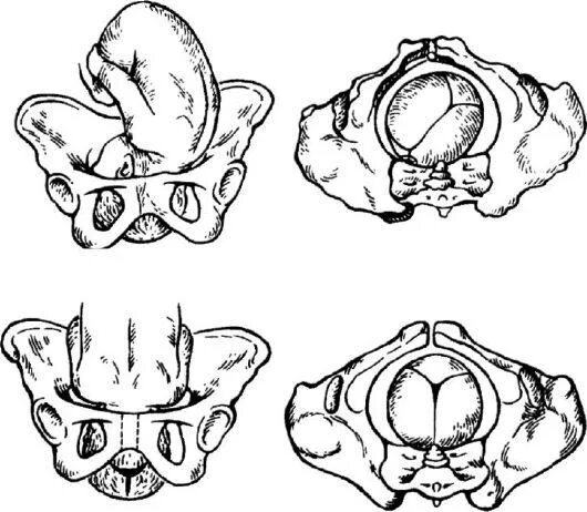 Бишопу акушерство. Передний вид затылочного предлежания биомеханизм родов. Задний вид затылочного предлежания биомеханизм родов. Механизм родов при переднем виде затылочного предлежания. Биомеханизм родов при переднем виде.