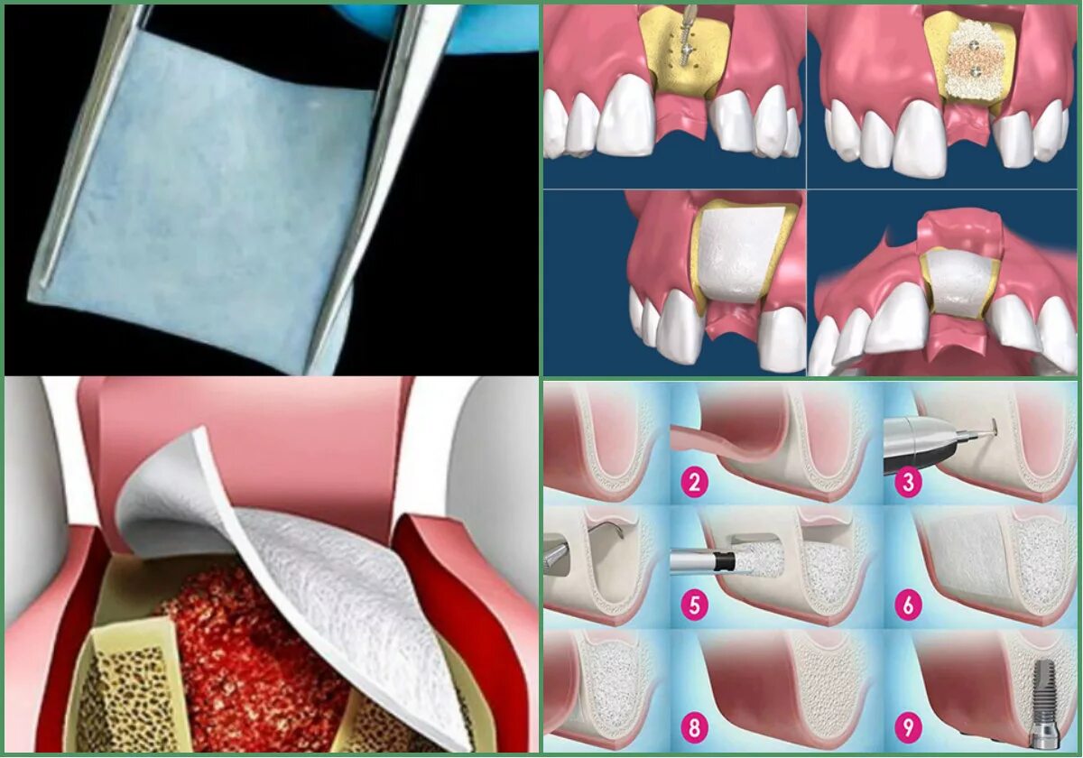 Остеопластика костной ткани челюстей. Костная пластика аугментация. Аугментация костной ткани. Открытый синус лифтинг. Костная пластика альвеолярного отростка.