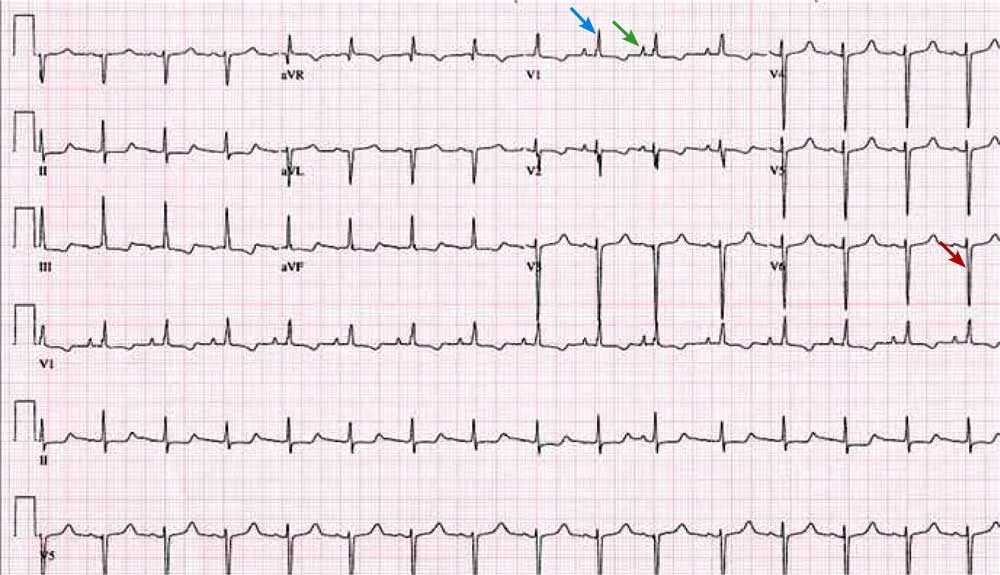 Экг 3 отведение норма. V1 v2 v3 на экг. Экг 2 отведение норма. V1 отведение экг. Элевация сегмента st в v1.