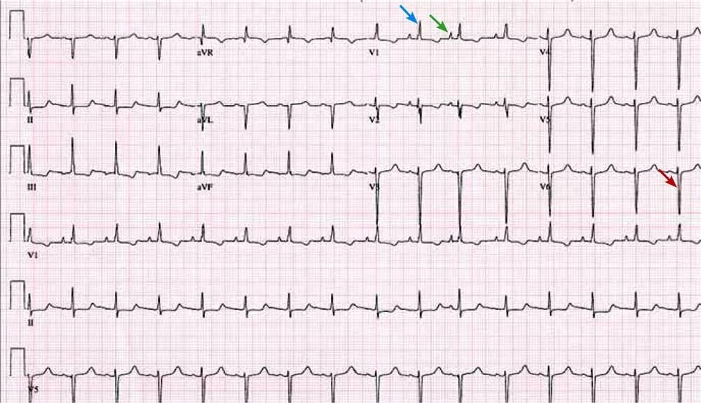 Отведение v1 на экг. ЭКГ высокий зубец r 12мм. В норме ЭКГ зубец p v1. Отведение v1 на ЭКГ норма.