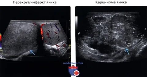 Яичко после перекрута