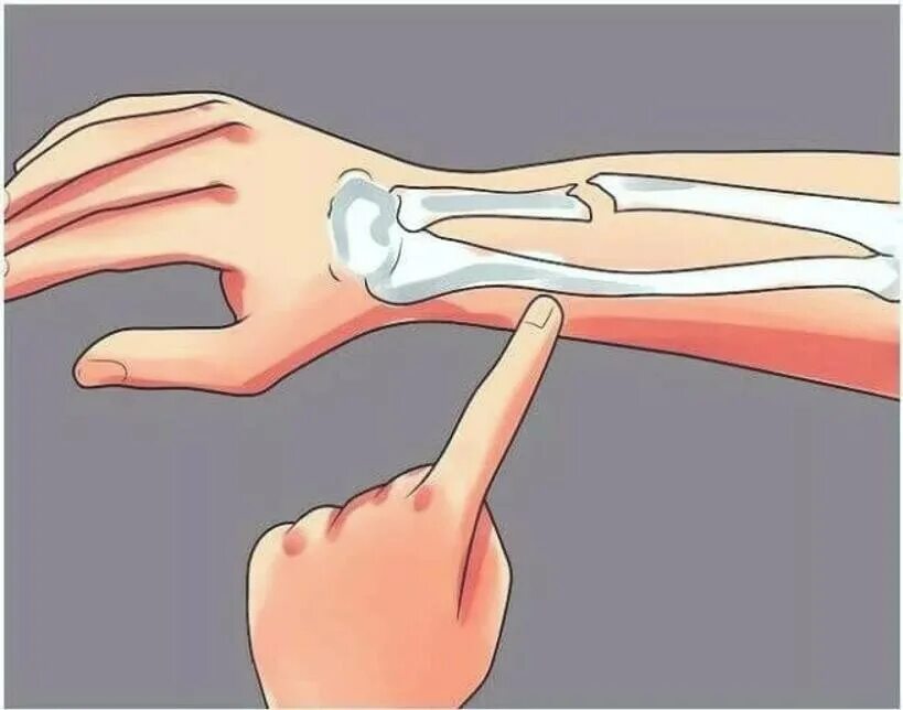 перелом лучезапястного сустава. перелом ладьевидной кости запястья. перелом диафиза локтевой кости кости. лучевая запястная кость. признаки трещины лучевая кость.