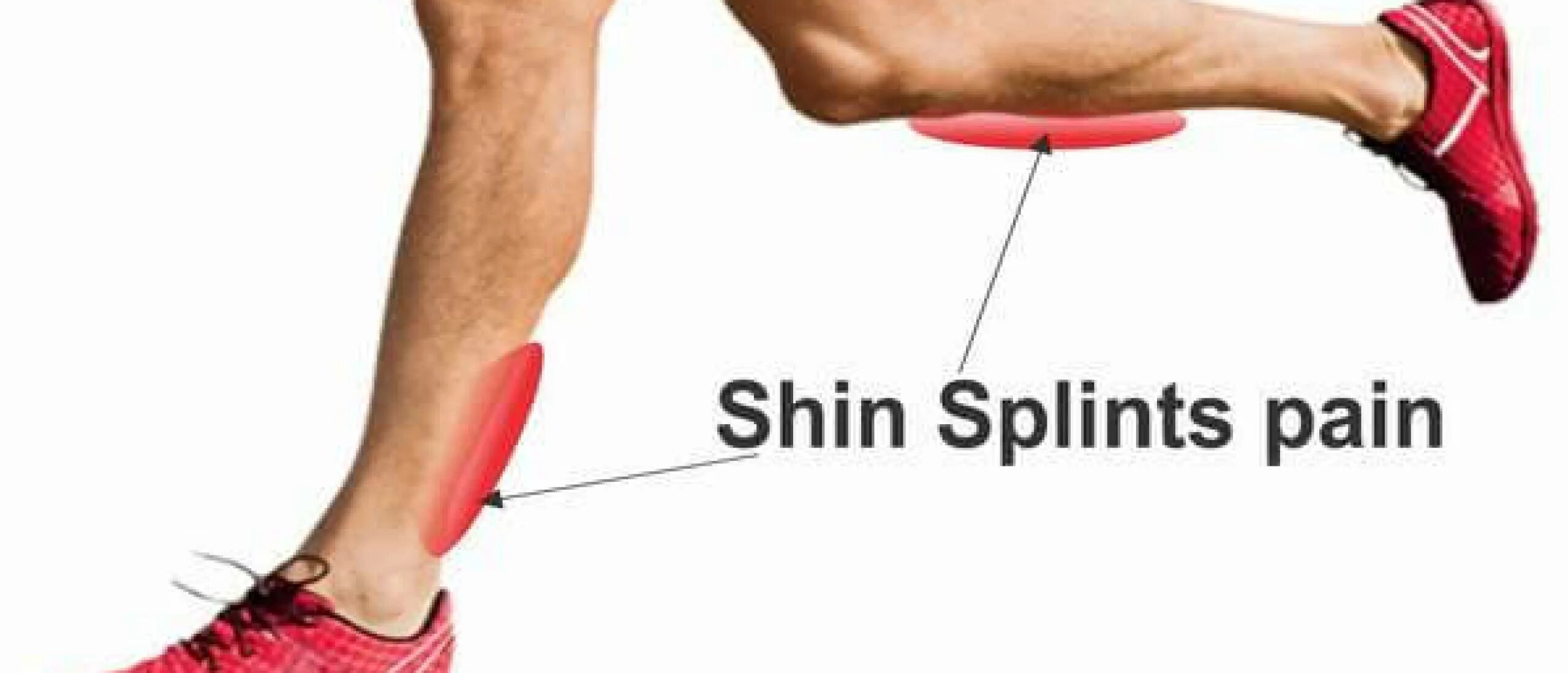Shin Splints. Медиальный большеберцовый стресс-синдром. Call leg