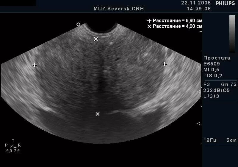 Аденома предстательной железы на УЗИ. Гиперплазия предстательной железы УЗИ. УЗИ доброкачественная гиперплазия предстательной железы. УЗИ картина аденомы предстательной железы. Простата обратиться