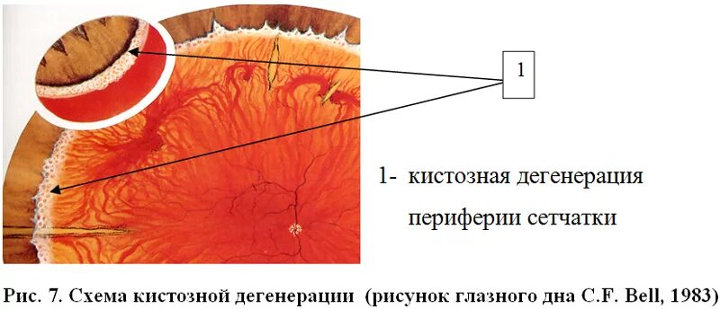 Периферические ретинальные дегенерации. Мелкокистозная дистрофия сетчатки глаза. Периферическая дистрофия сетчатки булыжная Мостовая. Дистрофия сетчатки булыжная Мостовая. Кистовидная (мелкокистозная) дистрофия сетчатки.