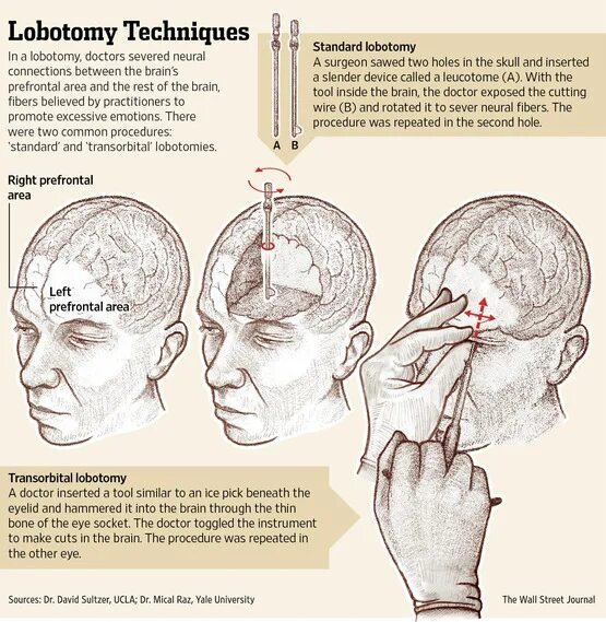 Префронтальная Лоботомия для чего. Лаботтмив. Трансорбитальная Лоботомия. Лоботомия делают ли