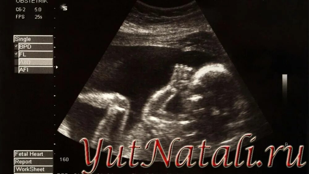 Как на узи определяют срок беременности. Какое узи выявляет беременность. 5 недель и 2 дня акушерской беременности узи. Скрининг в первый триместр беременности. Узи беременности на ранних сроках заключение.