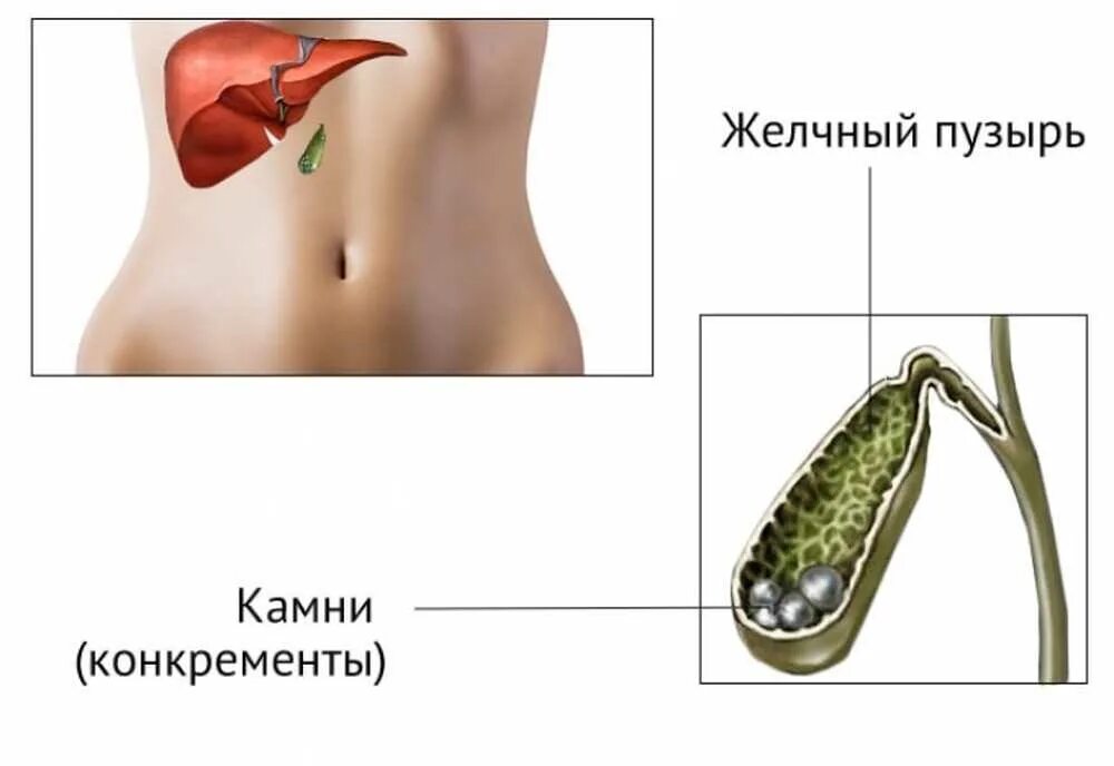 Желчный пузырь камни как болит