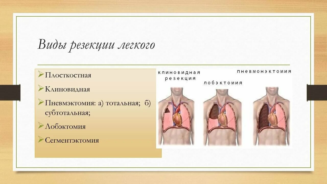 Туберкулез после операции. Резекция части легкого. Атипичная резекция лёгкого.