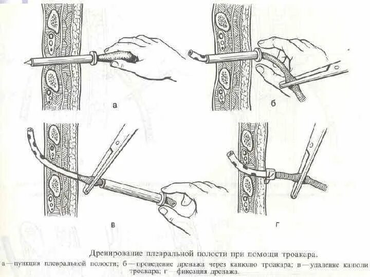 Пункция и дренирование плевральной полости. Дренаж для плевральной пункции. Троакар для дренирования плевральной полости. Дренирование плевральной пункции. Пункция через задний свод