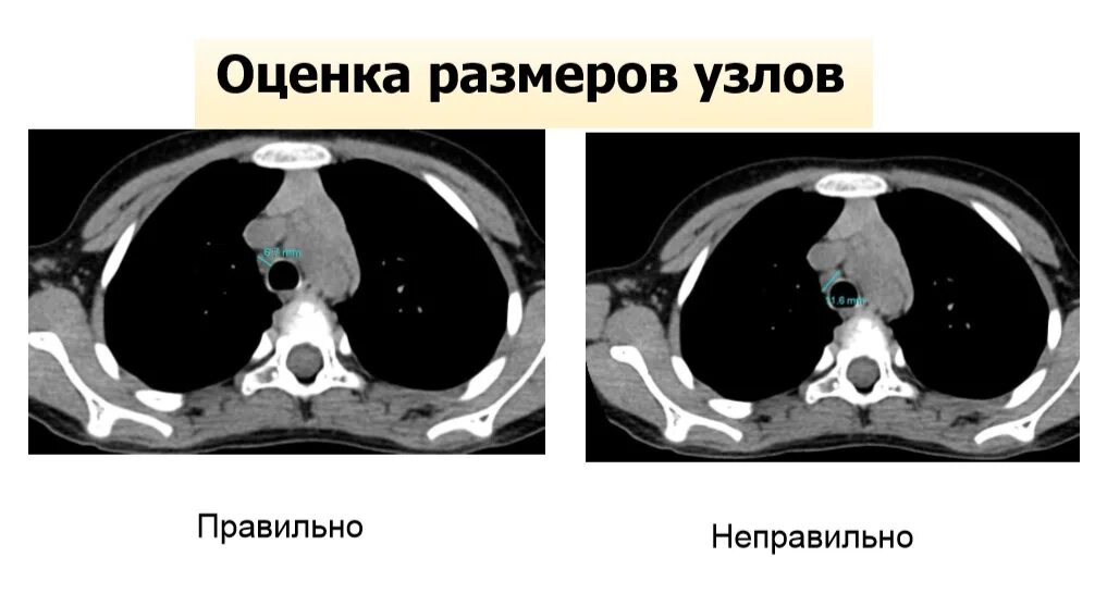 Короткая ось лимфоузла. Гиповентиляция легких на кт. Фиброателектаз легкого на кт. Эмфизема мягких тканей кт. Размер лимфоузлов по короткой оси.