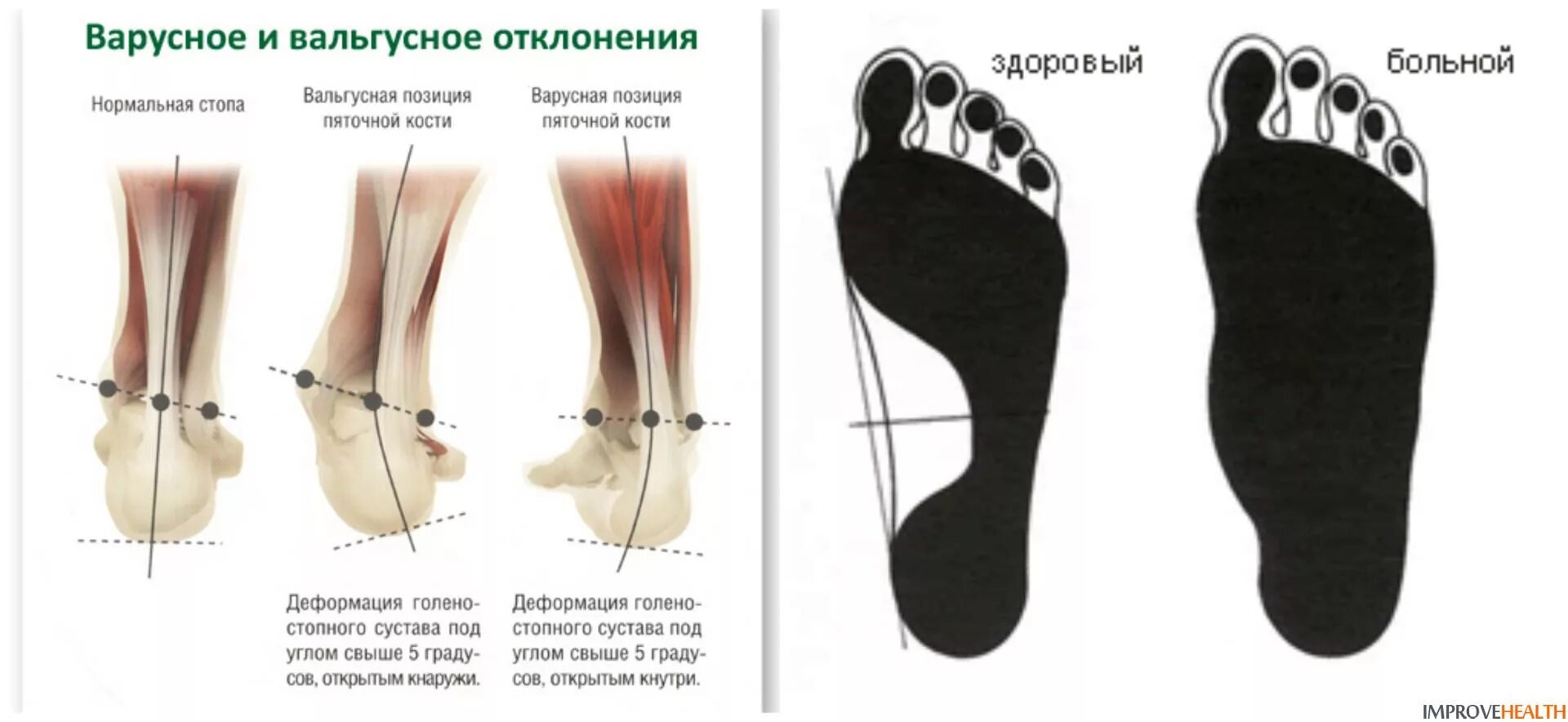 Нога имеет плоскую ползательную подошву. Плоско вальгусная варусная стопа. Вальгусная стопа и варусная стопа. Вальгус стопы это плоскостопие. Плоско варусная деформация стопы.