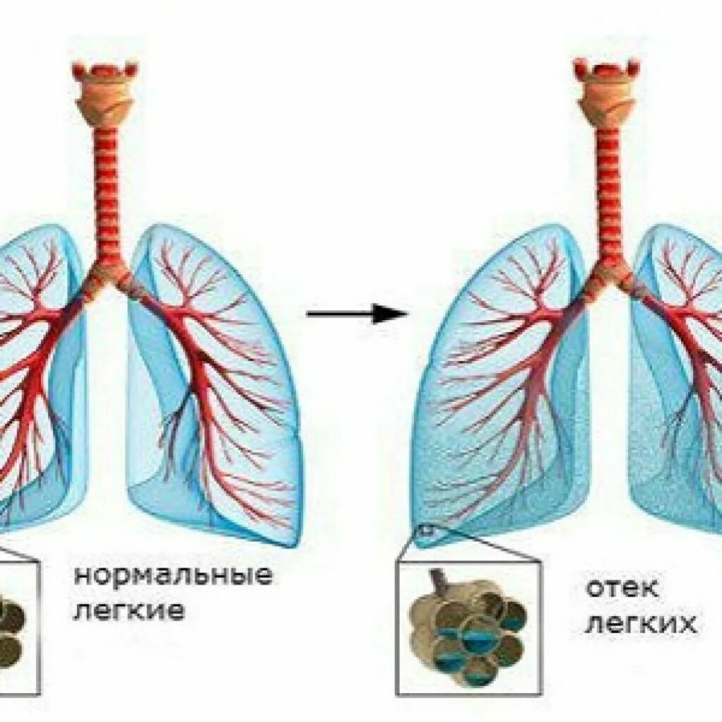 Отек легких жидкость