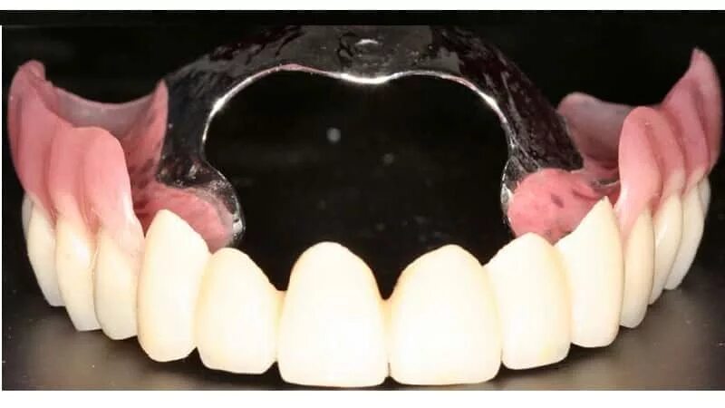 Снимать ли зубные протезы на ночь. Съемный протез на фронтальные зубы. Съемный протез на задние зубы.