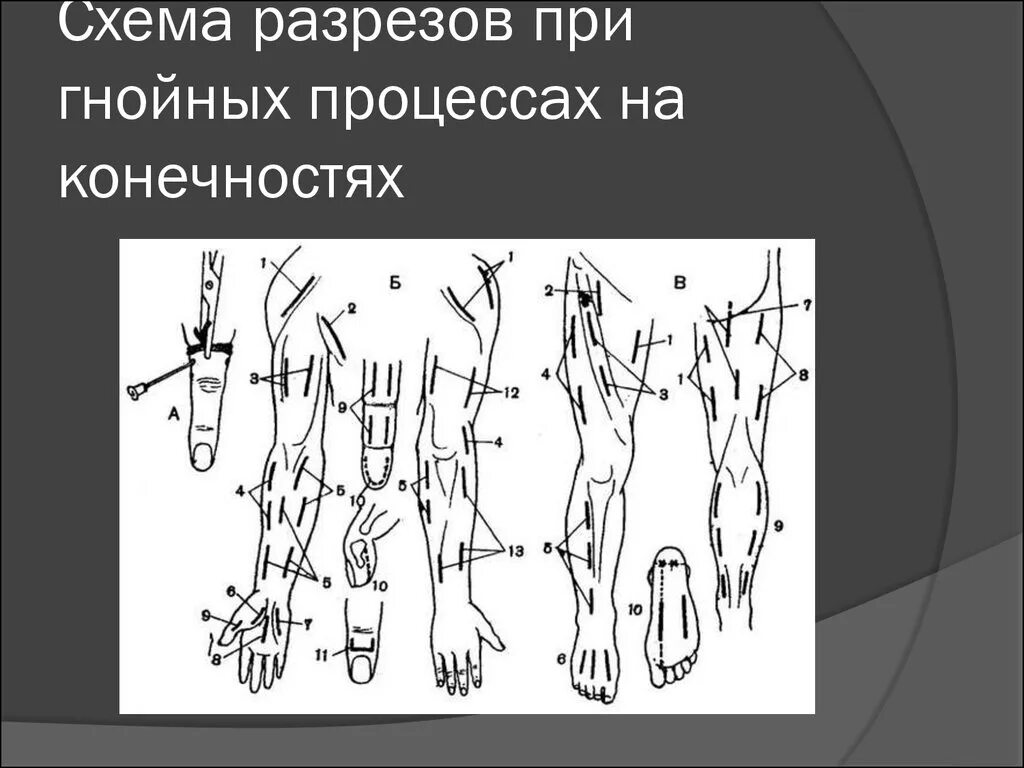 Операции верхних конечностей. Разрезы при флегмонах верхней конечности. Разрезы при флегмонах нижней конечности. Вскрытие флегмоны верхней конечности. Разрезы при флегмонах верхней и нижней конечностей.