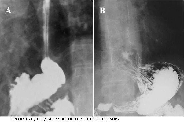 Скользящая грыжа пищевода рентгенограмма. Параэзофагеальная грыжа пищевода на рентгене. Рентген пищевода грыжа пищевода.