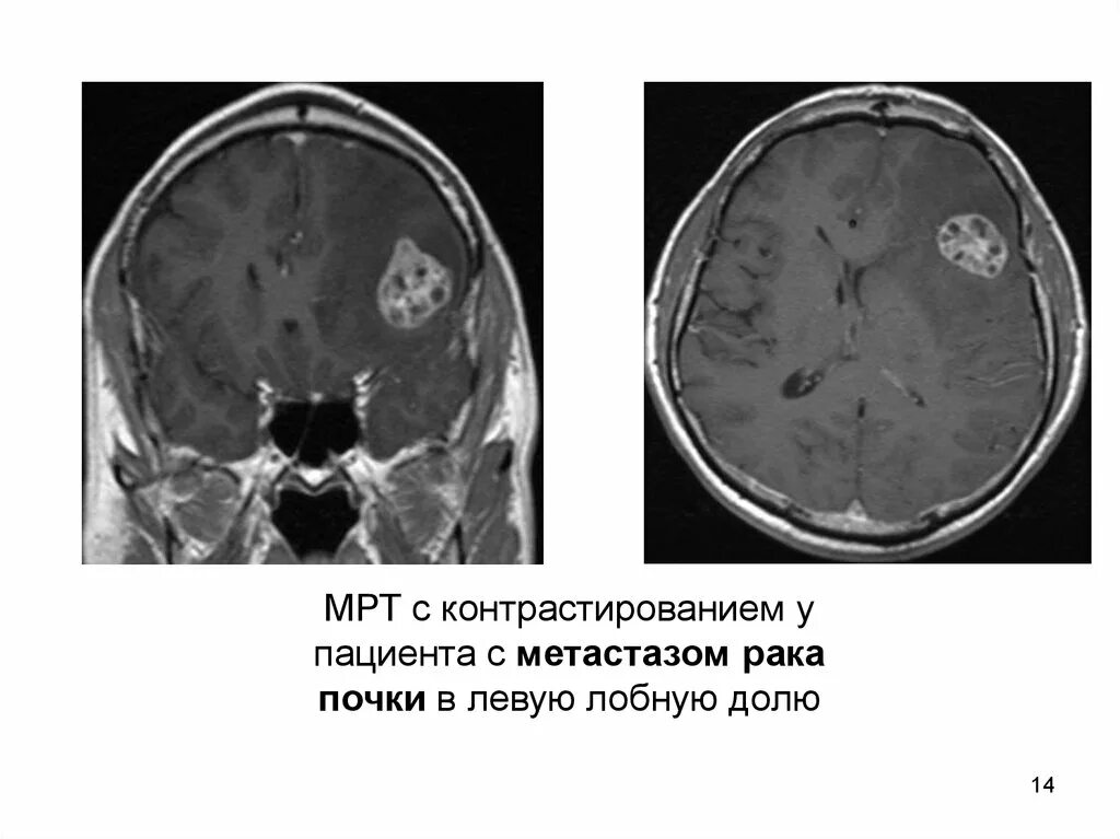 Метастазы рака почки