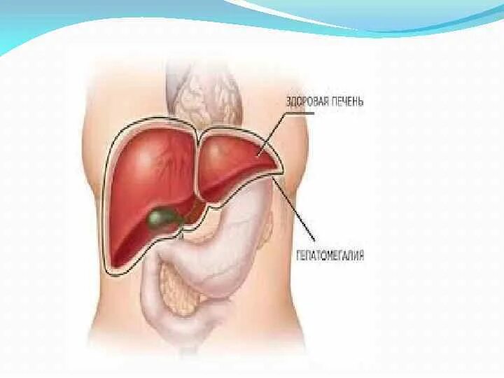 Гепатомегалия печени что это такое у женщин. Гепатомегалия печени. Гепатомегалия симптомы. Эхопризнаки гепатомегалии.