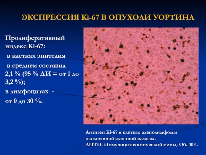 Индекс пролиферативной активности. Индекс пролиферации ki 67. Фокальная Экспрессия в клетках опухоли. Экспрессия клеток это. Индекс пролиферации в опухолевых клетках.