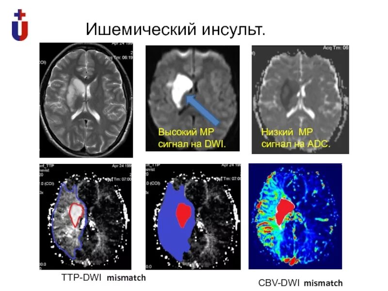 Стадии геморрагического инсульта кт. Ишемический инсульт кт и мрт. Ишемический инсульт на кт головного мозга. Ишемический инсульт мрт Dwi.