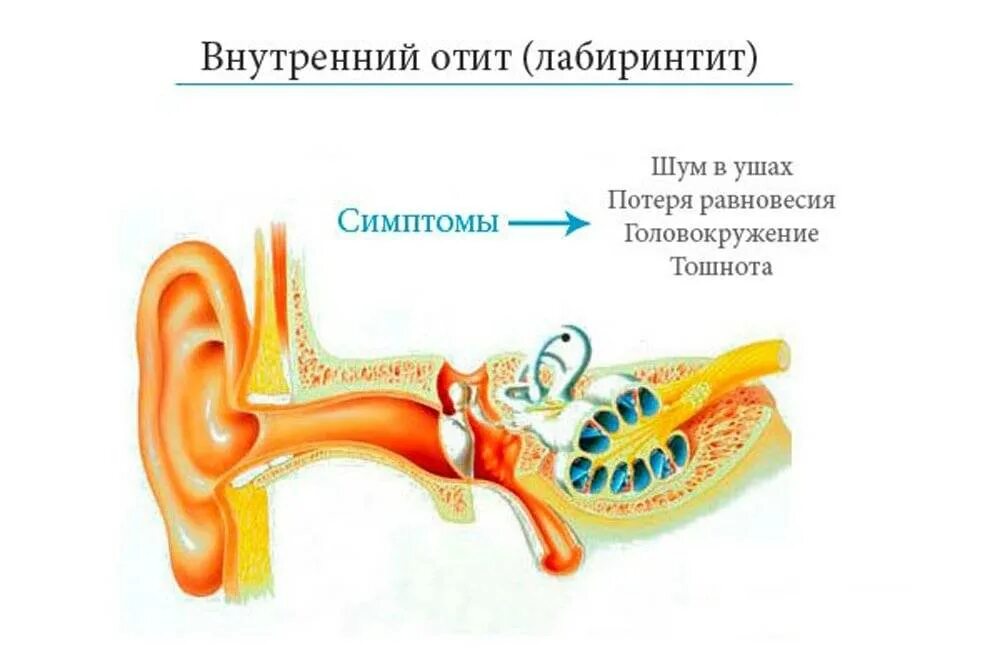 Воспаление внутреннего уха лабиринтит. Воспаление среднего уха (лабиринтит);. Воспаление среднего уха лабиринтит симптомы. Воспалительные заболевания внутреннего уха (лабиринтиты).. Болезнь внутреннего уха