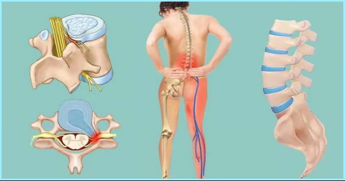 Радикулит поясничный симптомы. Упражнения для спины при грыже грудного отдела позвоночника. Упражнения для поясничного отдела позвоночника при болях. Декомпрессионная ламинэктомия l1 позвонка. Операция на поясничном отделе.