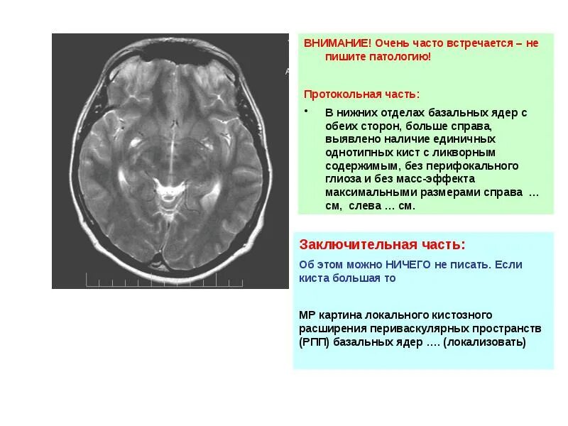 Постишемические кисты мозга. Киста в базальных ядрах. Ликворная киста базальных ядер. Киста в подкорковых ядрах. Лакунарная ликворная киста.