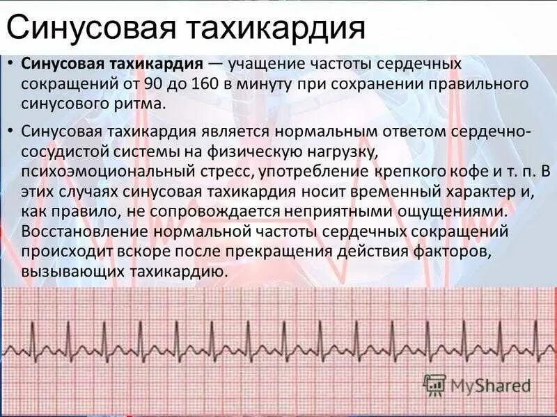 Сильный пульс что делать. Синусовая тахикардия (110 уд/мин). Синусовая тахикардия ЧСС 140. Синусовая тахикардия ЧСС 100 ЭКГ. Пароксизмальная синусовая тахикардия.