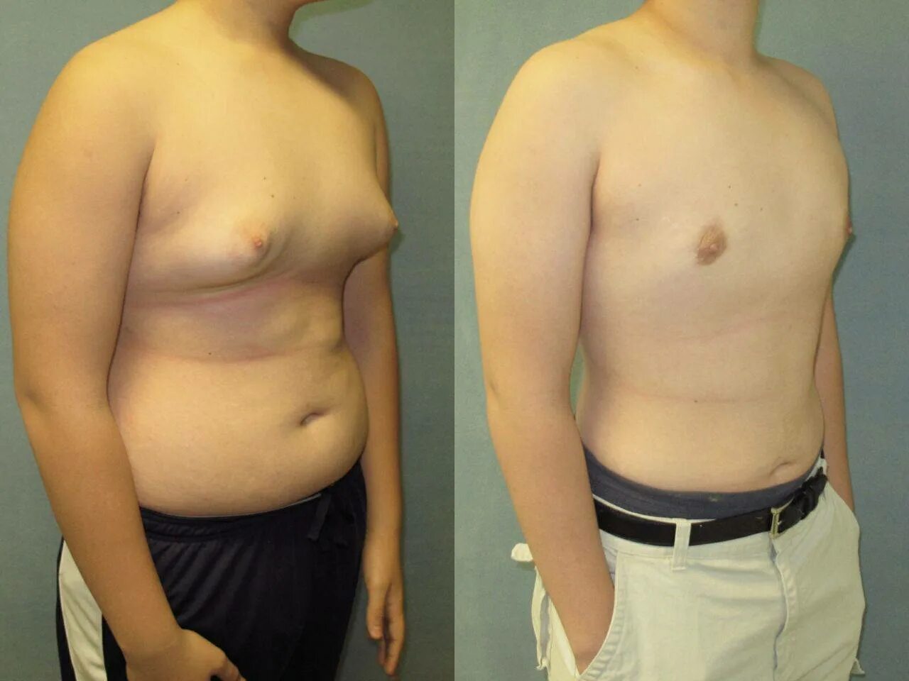 Гинекомастиятамоксиен. Фиброзная гинекомастия. Сыроедческая гинекомастия. Пролактинома гинекомастия. Гинекомастия андрогель.