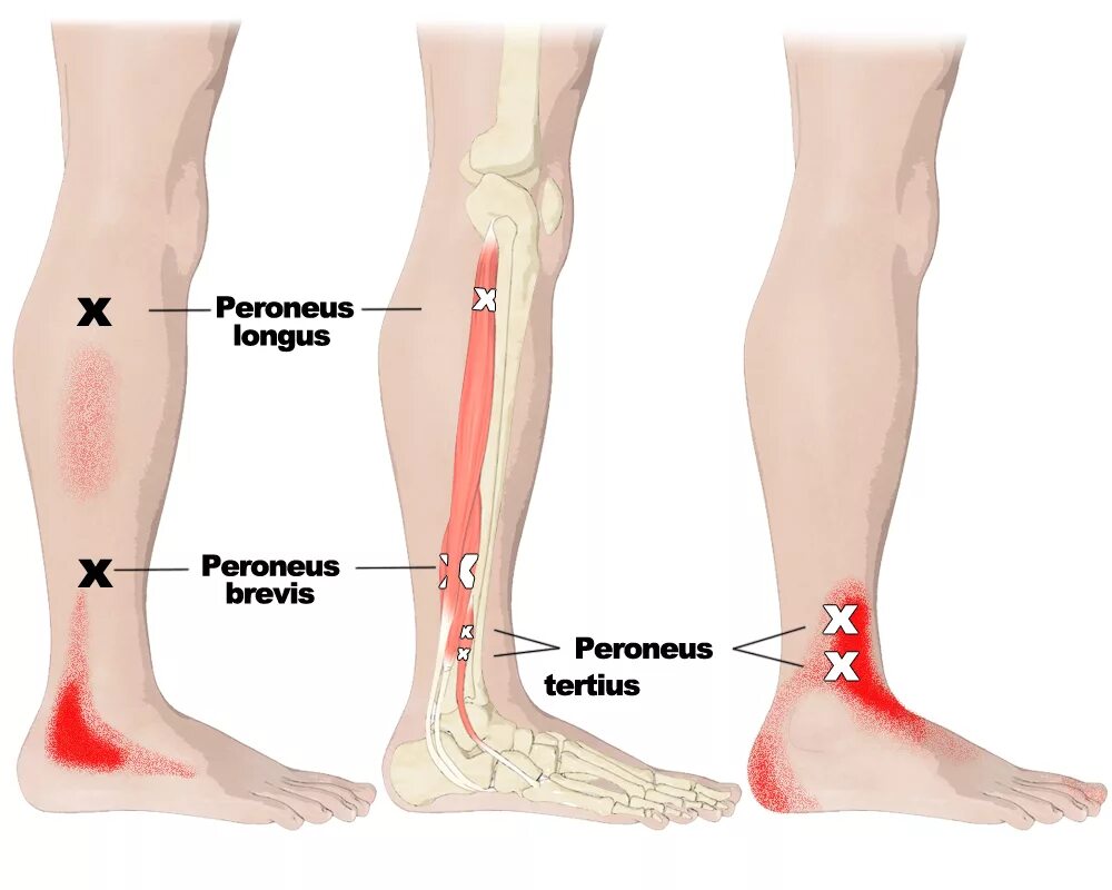 Сильная боль внизу ноги. Перонеус Лонгус. Триггерные точки икроножной мышцы. Триггерные точки мышц голени.