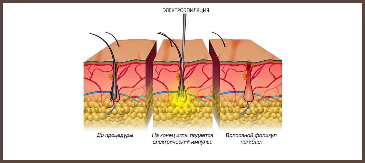 Электроэпиляция картинки. Волосяной фолликул. Электроэпиляция схема. Можно ли удалять волосы лазером