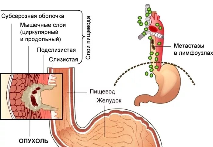 Пищевода выживаемость