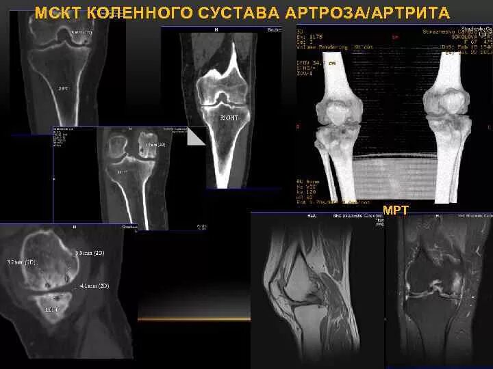 Артрит кт. Ревматоидный артрит коленного сустава мрт. Остеоартроз коленного сустава мрт. Ревматоидный артрит колена кт. Артроз коленного сустава классификация мрт.