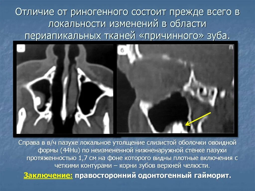 Пристеночное утолщение слизистой оболочки. Периапикальная область. Периапикальных тканей зуба. Изменения в периапикальной области.