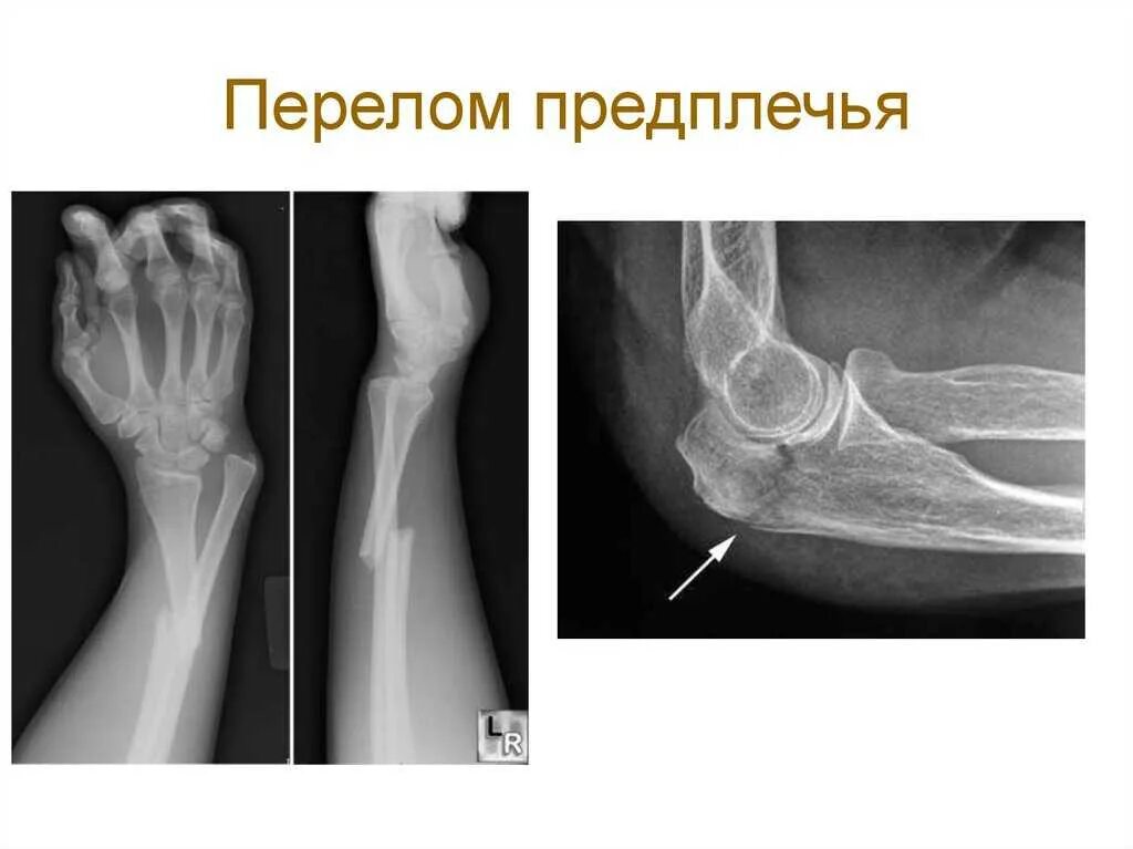 Открытый перелом кости руки. Продольный перелом лучевой кости. Перелом 2х костей предплечья со смещением. Перелом диафиза лучевой кости. Локтевая кость перелом.