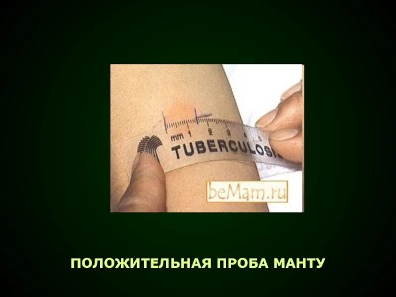 Положительная проба манты. Положительная туберкулиновая проба манту. Резко положительная реакция