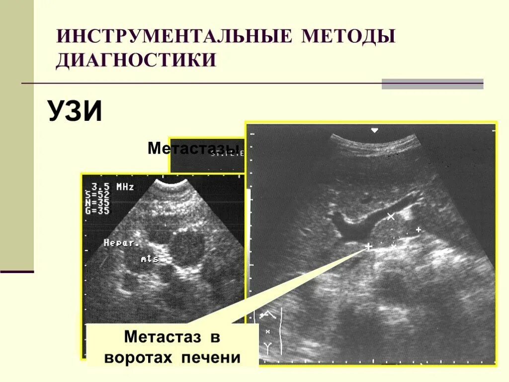 Новообразование в печени на УЗИ. На узи виден желудок