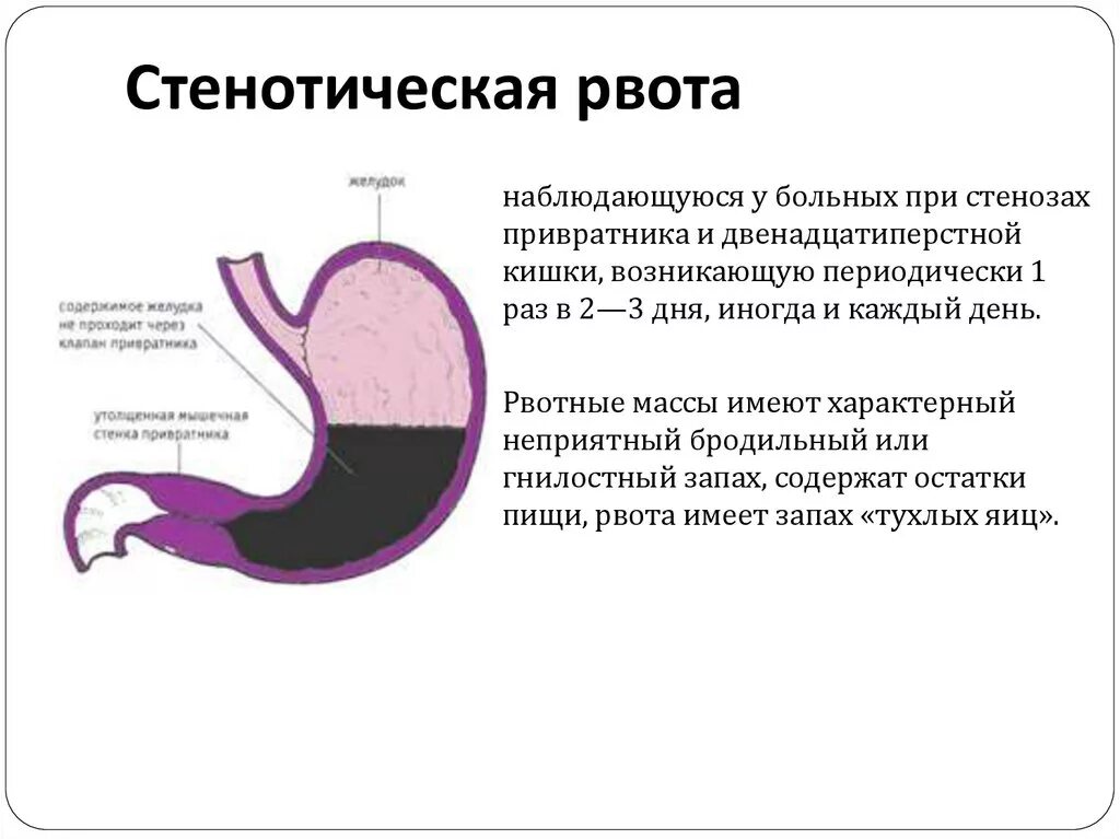 Отрыжка с запахом тухлых яиц. Рвота с запахом тухлых яиц. Стеноз привратника причины.